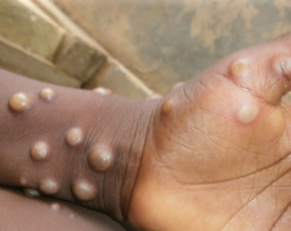 Health workers in Nigeria spreading awareness about Mpox prevention.