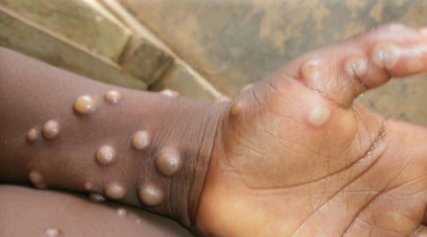 Health workers in Nigeria spreading awareness about Mpox prevention.